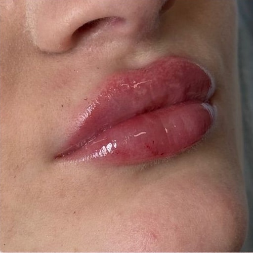 After Image: Restylane - right-front-oblique