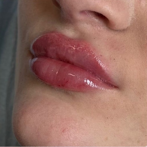 After Image: Restylane - left-front-oblique
