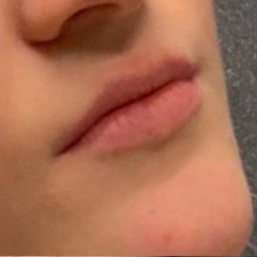 Before Image: Restylane - right-front-oblique