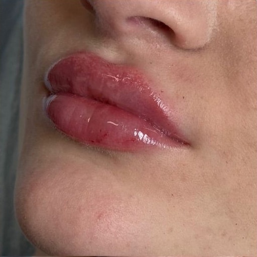 Before Image: Restylane - left-front-oblique