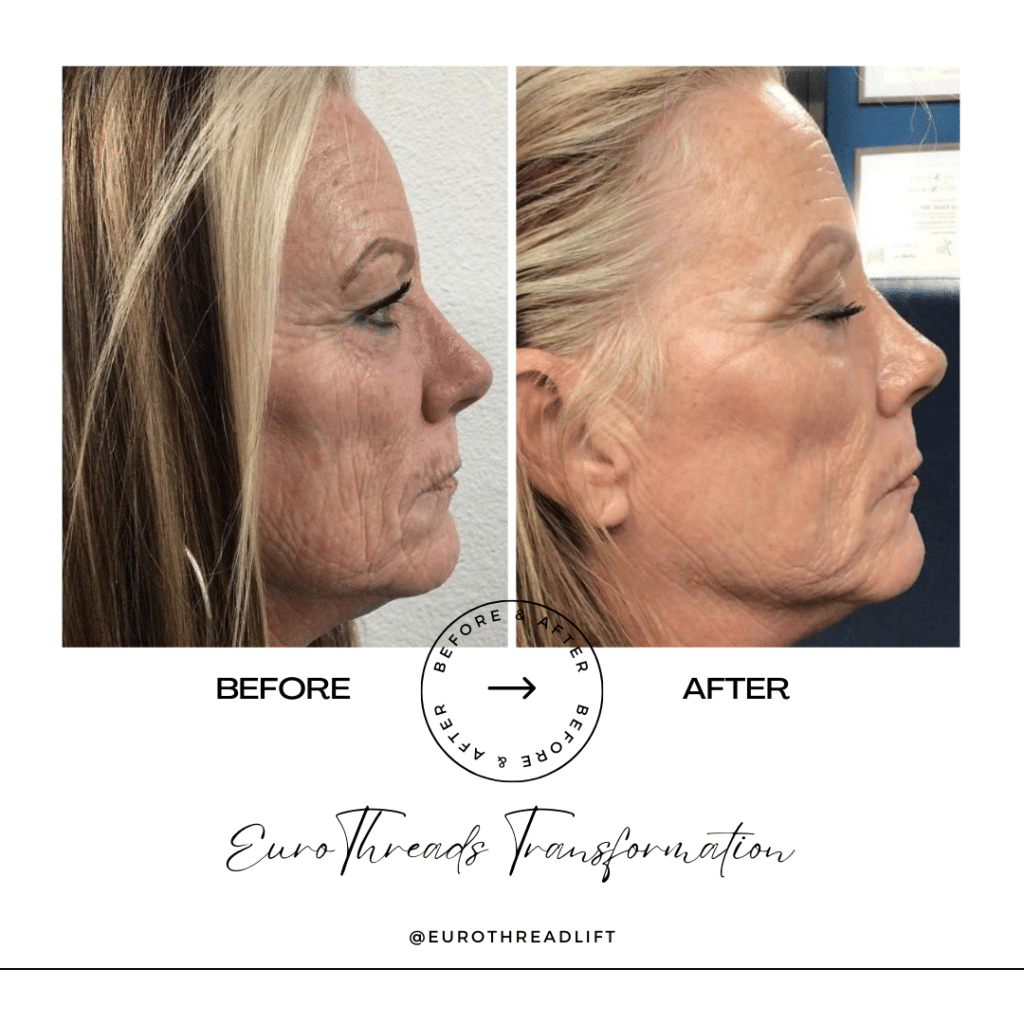 1770844540_4d60428502344fd09578e60b050173fb PDO Threads in Grapevine, TX