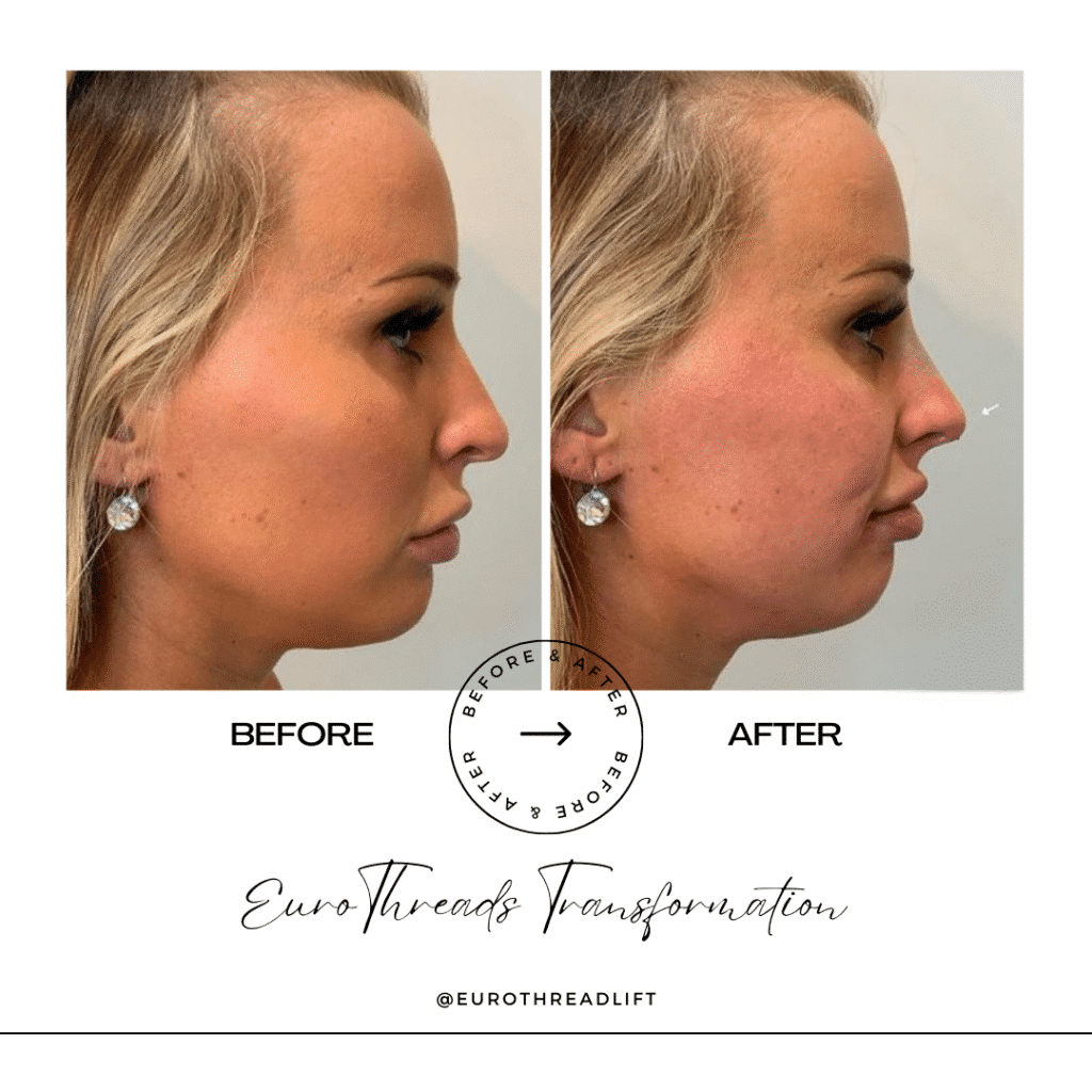 1770844544_533f61c2be0a442794940d3d24170c3c-1-1 PDO Threads in Grapevine, TX