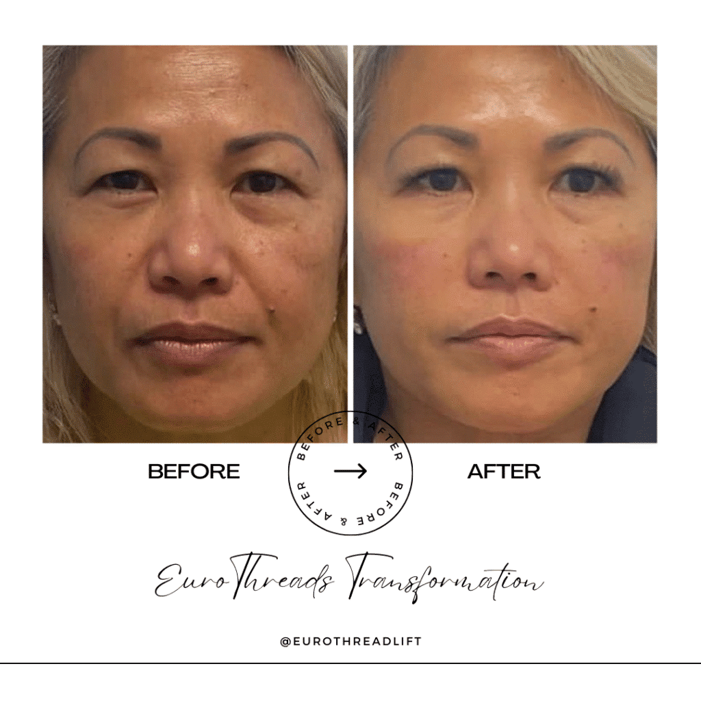 1770844580_52fd214e5ae643338b8d9474cc1135de-1-1 PDO Threads in Grapevine, TX