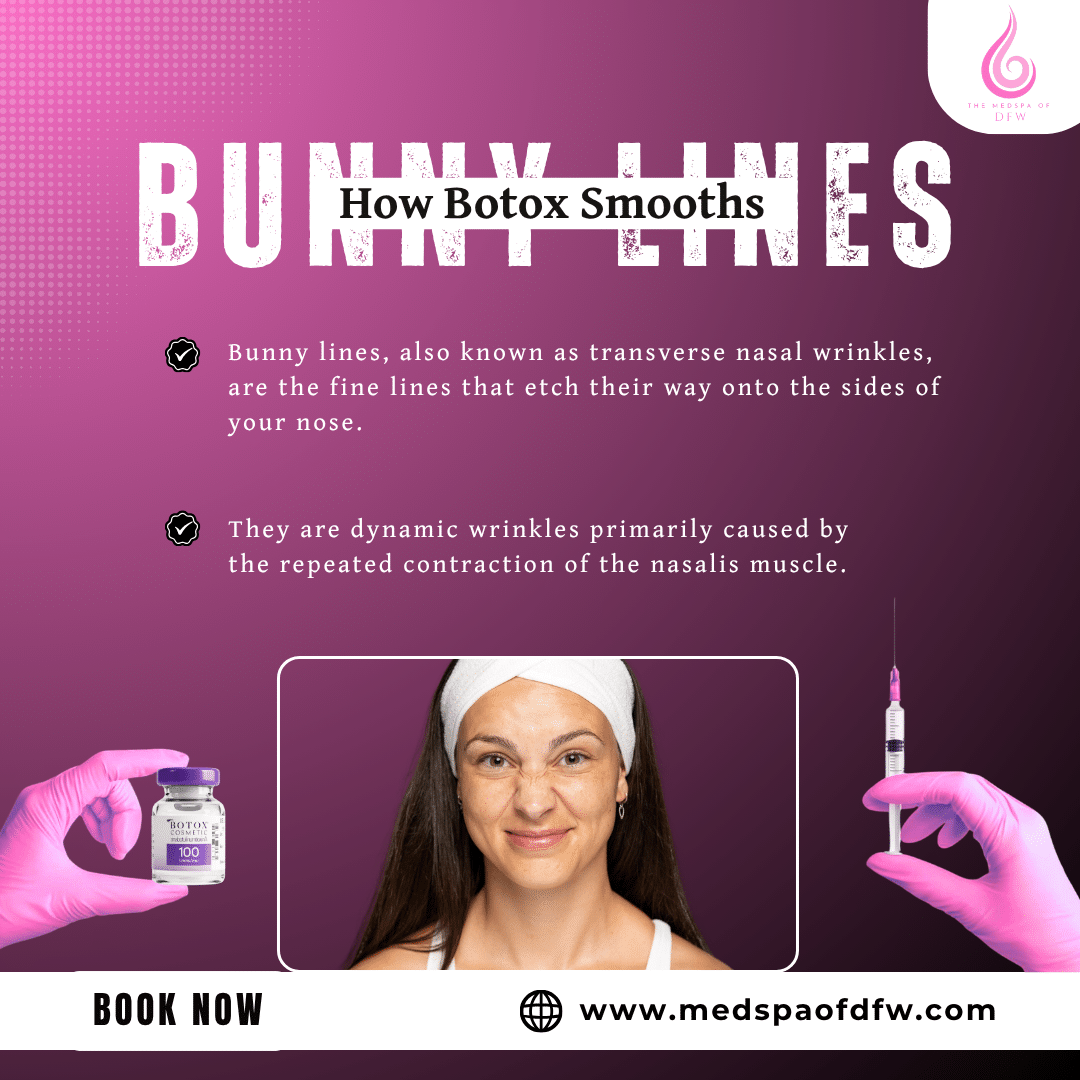 What Are Bunny Lines?