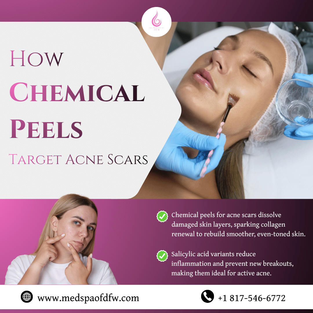How Chemical Peels Target Acne Scars