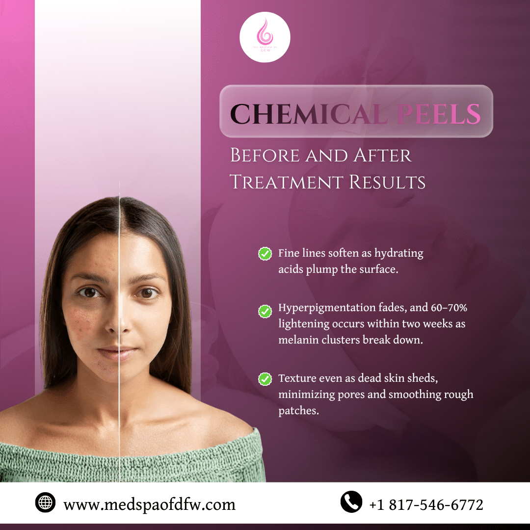 Chemical Peels Before and After Treatment Results