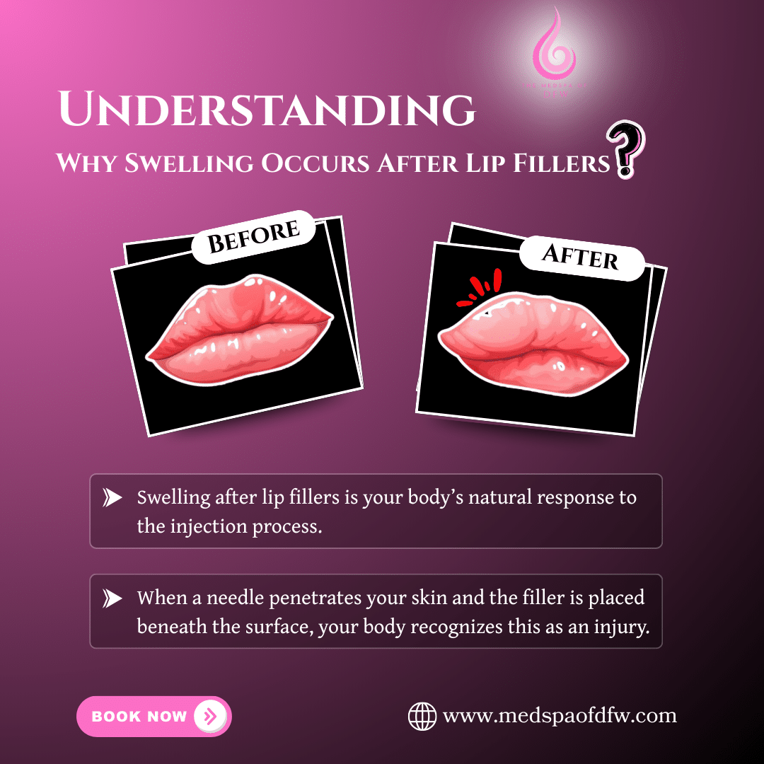 Understanding Why Swelling Occurs After Lip Fillers
