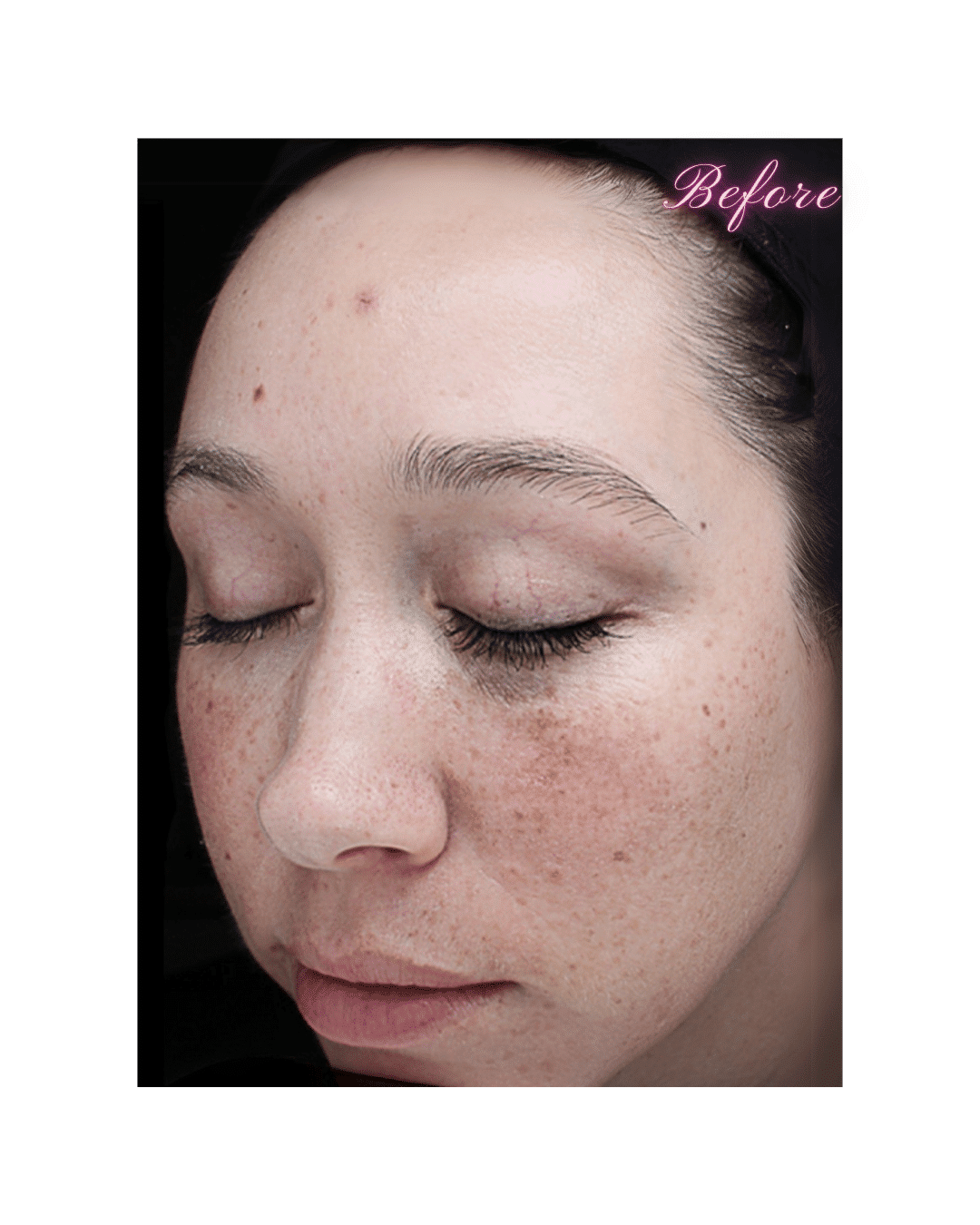 VI Peels in Grapevine, TX