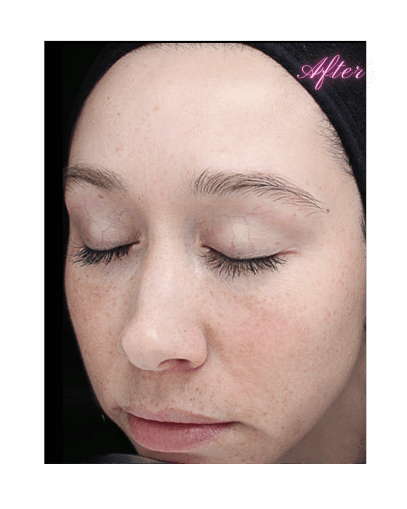 VI Peels in Grapevine, TX