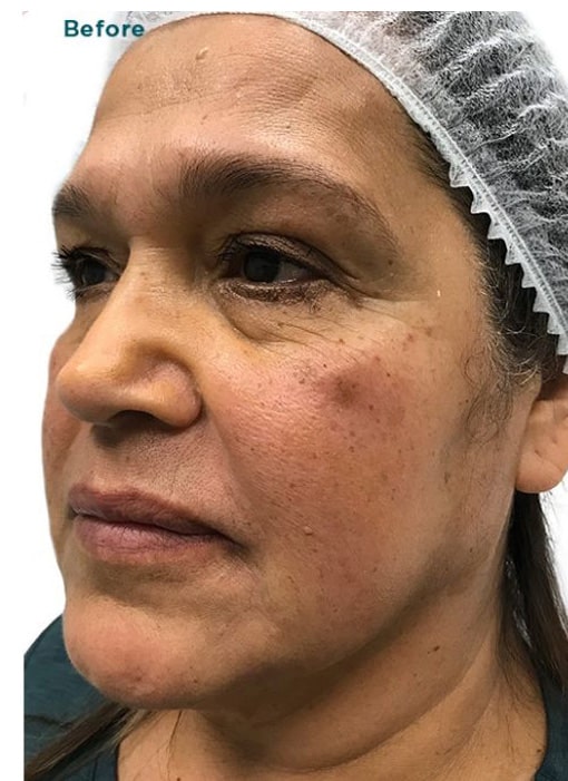 Before Image: VI Peel, Neurotoxin - left-front-oblique