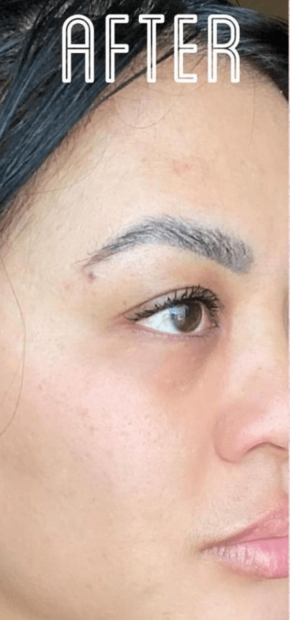 After Image: VI Peel - right-front-oblique