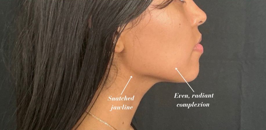 After Image: VI Peel, Masseter Tox - right-side