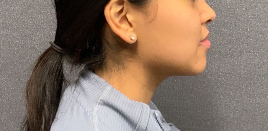 Before Image: VI Peel, Masseter Tox - right-side