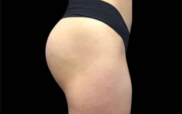 After Image: Emsculpt - right-side