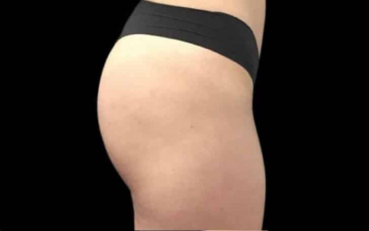 Before Image: Emsculpt - right-side