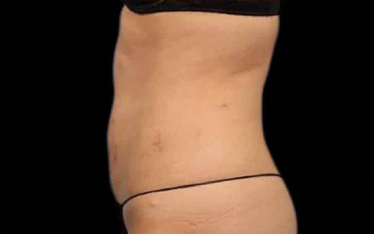 After Image: Emsculpt - left-side