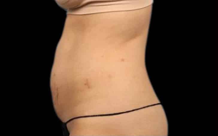 Before Image: Emsculpt - left-side