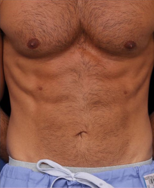 After Image: Emsculpt - front