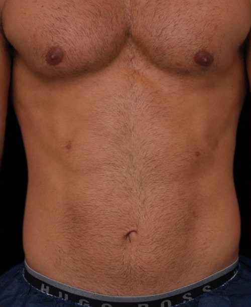 Before Image: Emsculpt - front