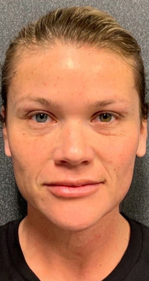 After Image: Aerolase, VI Peel, Sculptra - front