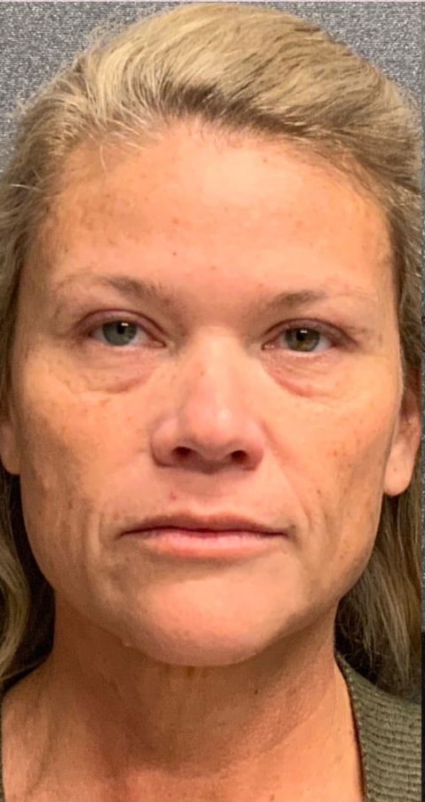 Before Image: Aerolase, VI Peel, Sculptra - front