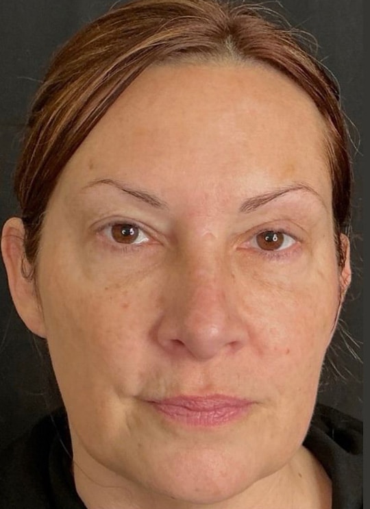 After Image: Nouvaderm, Under Eye Filler, & Tox - front