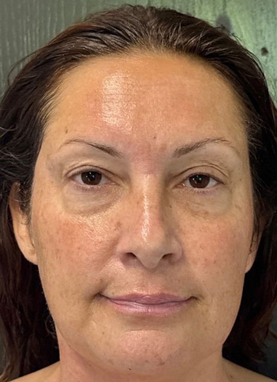 Before Image: Nouvaderm, Under Eye Filler, & Tox - front