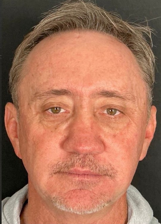 After Image: Nouvaderm, Filler & Tox - front