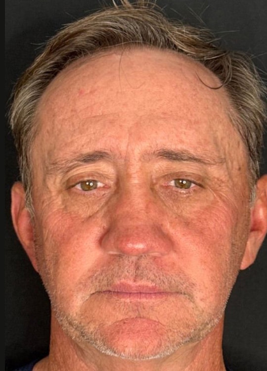 Before Image: Nouvaderm, Filler & Tox - front