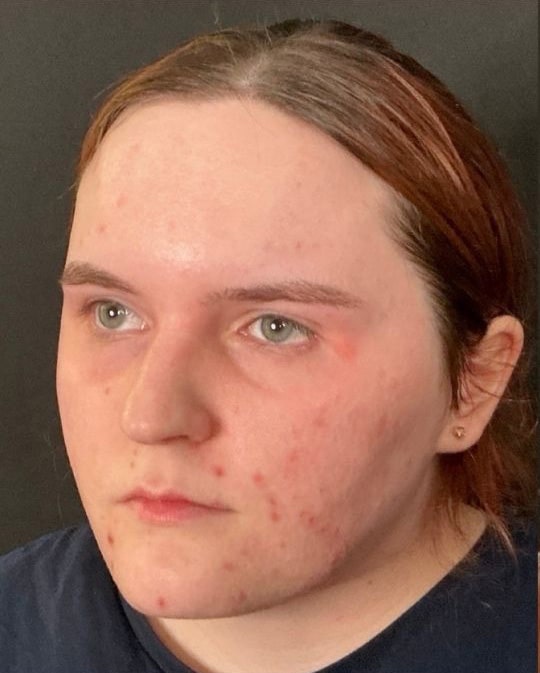 Before Image: Aerolaser/VI Peel - left-front-oblique