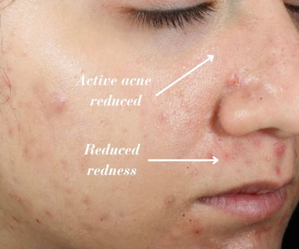 After Image: Epionce Acne Regimen - right-front-oblique