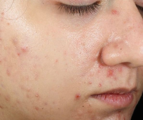 Before Image: Epionce Acne Regimen - right-front-oblique
