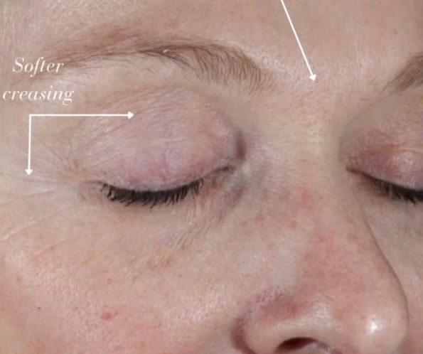 After Image: Epionce Anti-aging Regimen - right-front-oblique