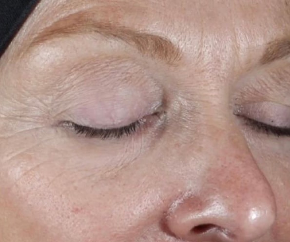 Before Image: Epionce Anti-aging Regimen - right-front-oblique