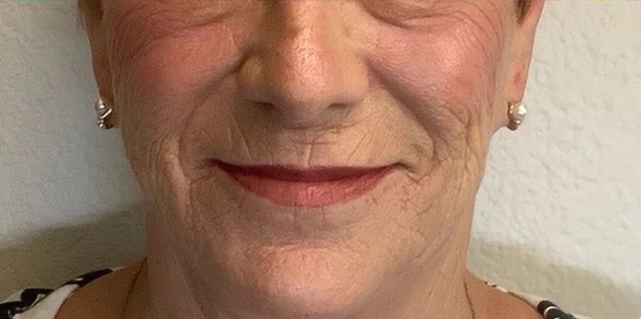 After Image: VI Peel - front