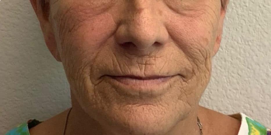 Before Image: VI Peel - front