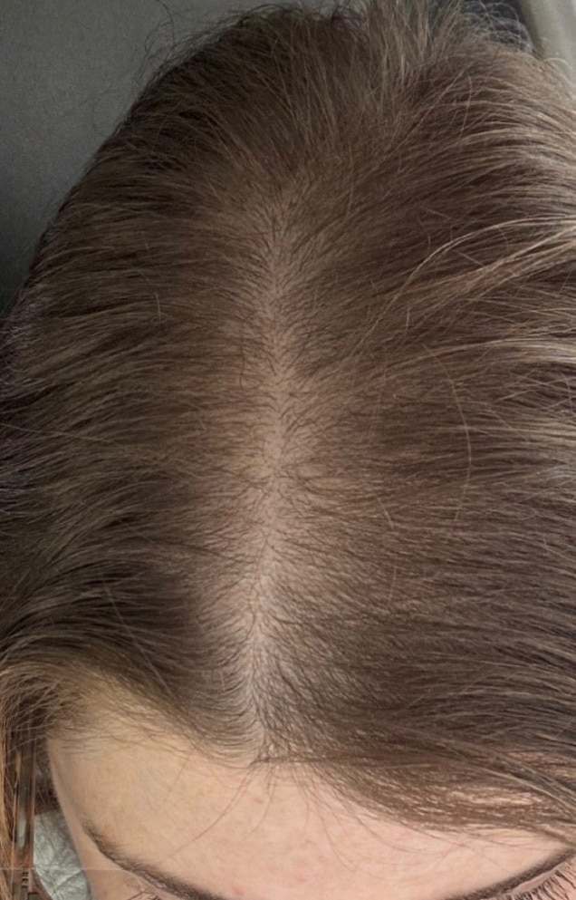 After Image: Hair Restoration - front