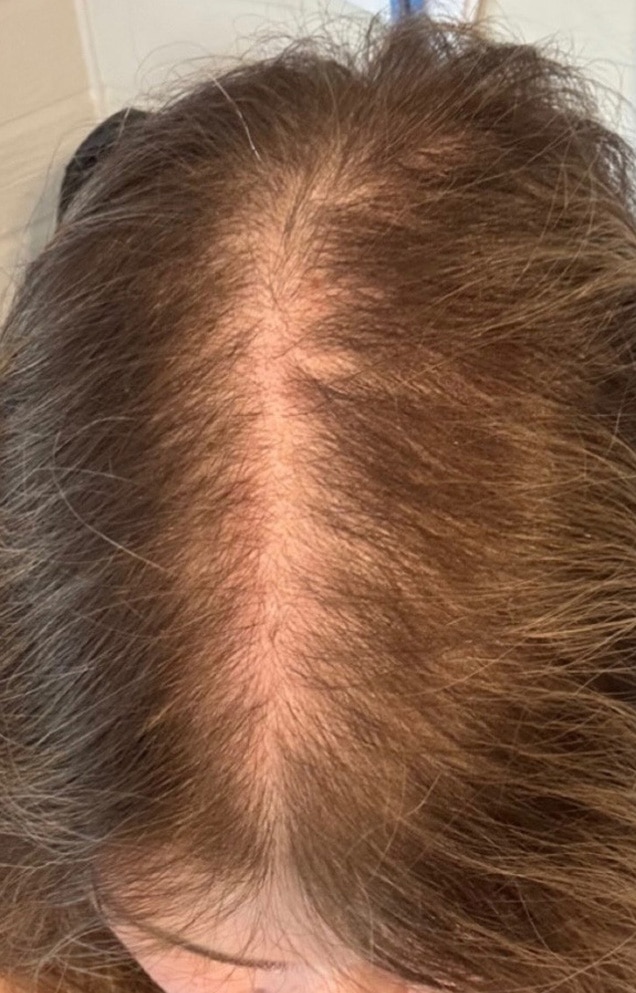 Before Image: Hair Restoration - front