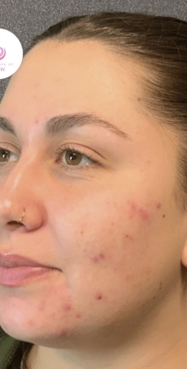 After Image: Aerolase/VI Peel - left-front-oblique