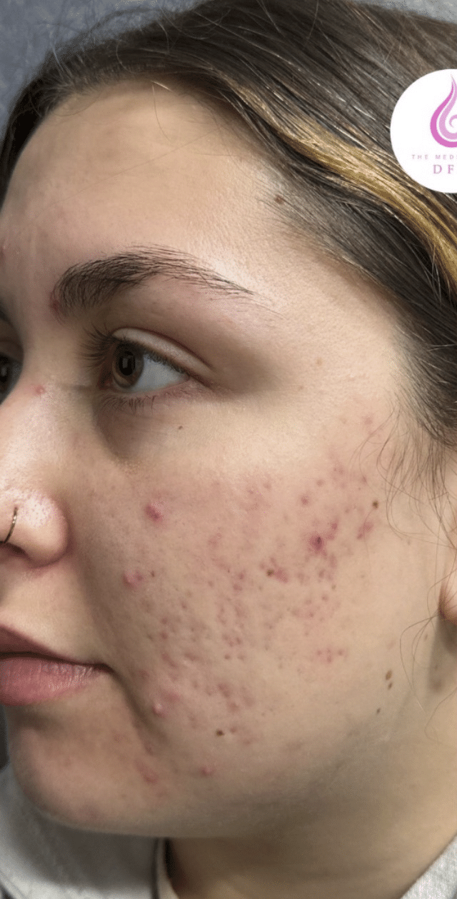 Before Image: Aerolase/VI Peel - left-front-oblique