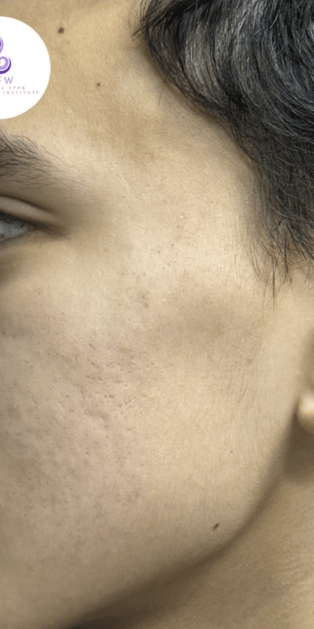 After Image: Aerolase/VI Peel - left-front-oblique