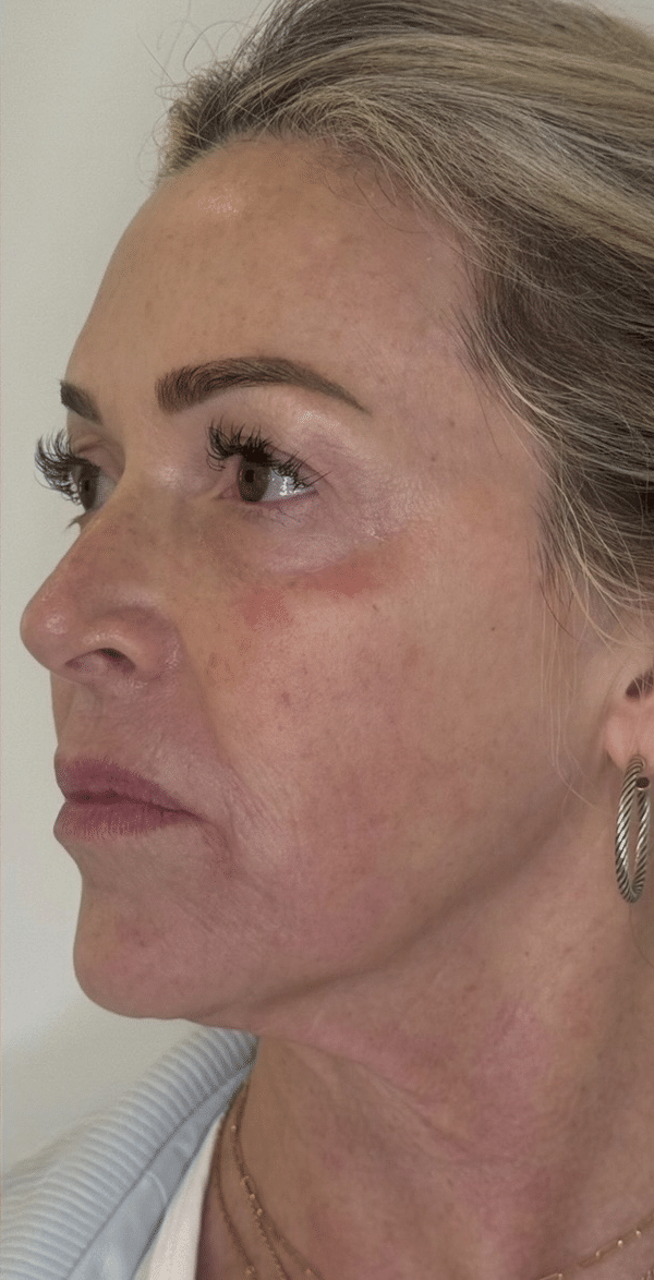 After Image: Nouvaderm - left-front-oblique