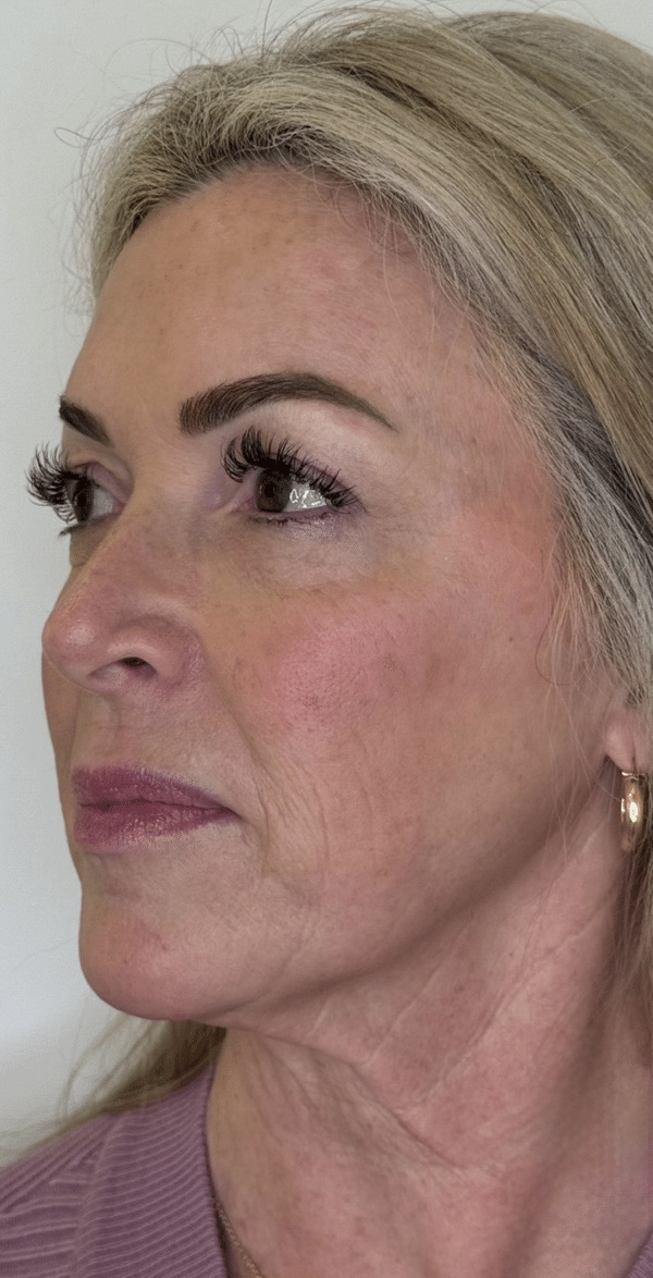 Before Image: Nouvaderm - left-front-oblique