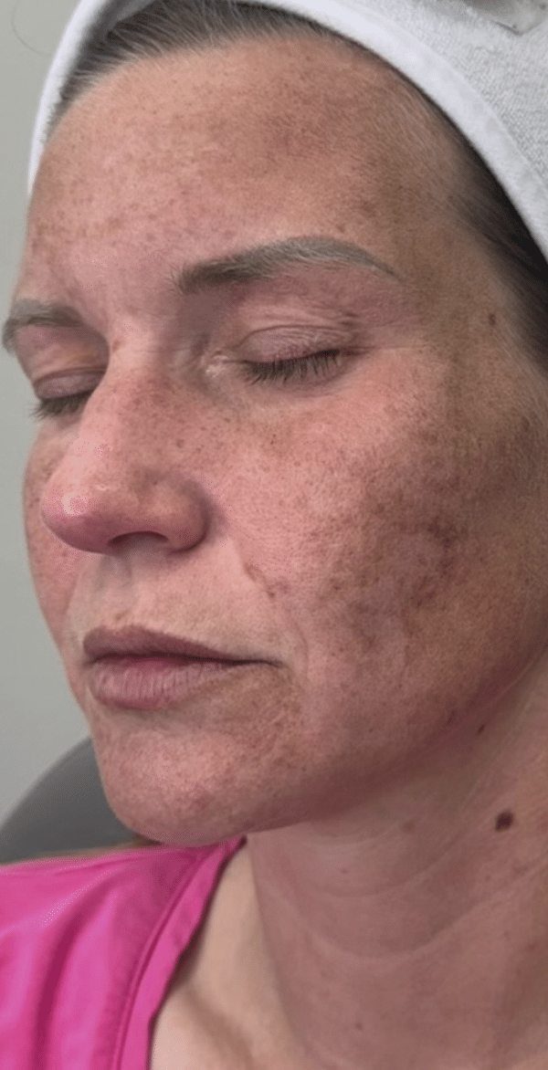 Before Image: Nouvaderm - left-front-oblique