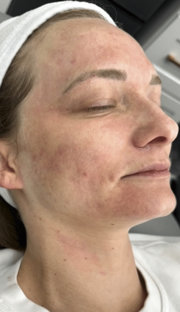 Before Image: Nouvaderm - right-front-oblique