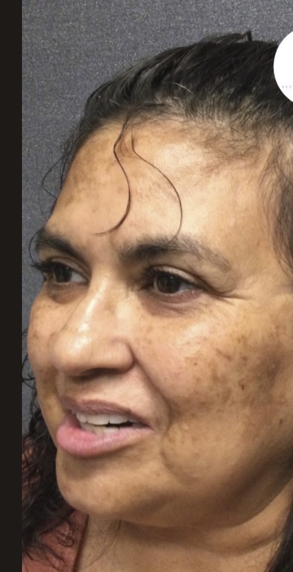 Before Image: Aerolase/VI Peel - left-front-oblique