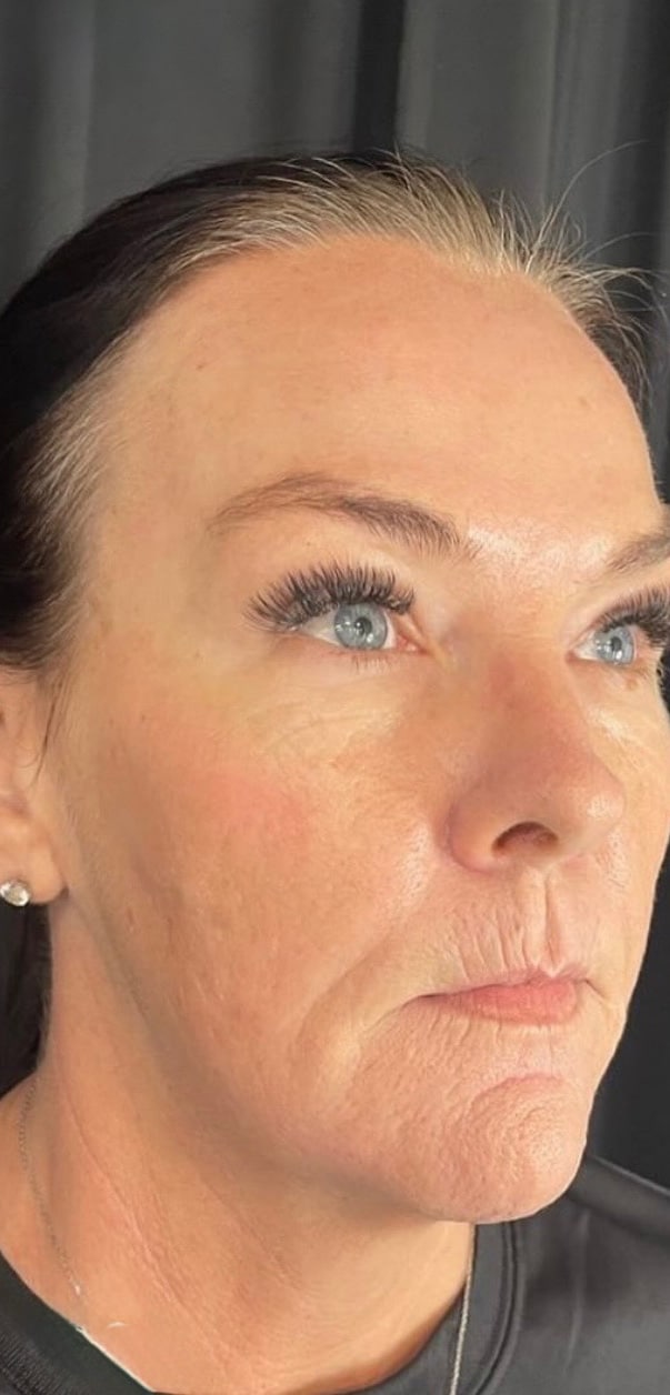 After Image: Nouvaderm - right-front-oblique