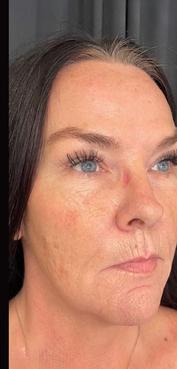 Before Image: Nouvaderm - right-front-oblique