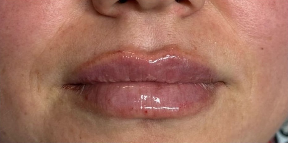 After Image: Lip Filler - front