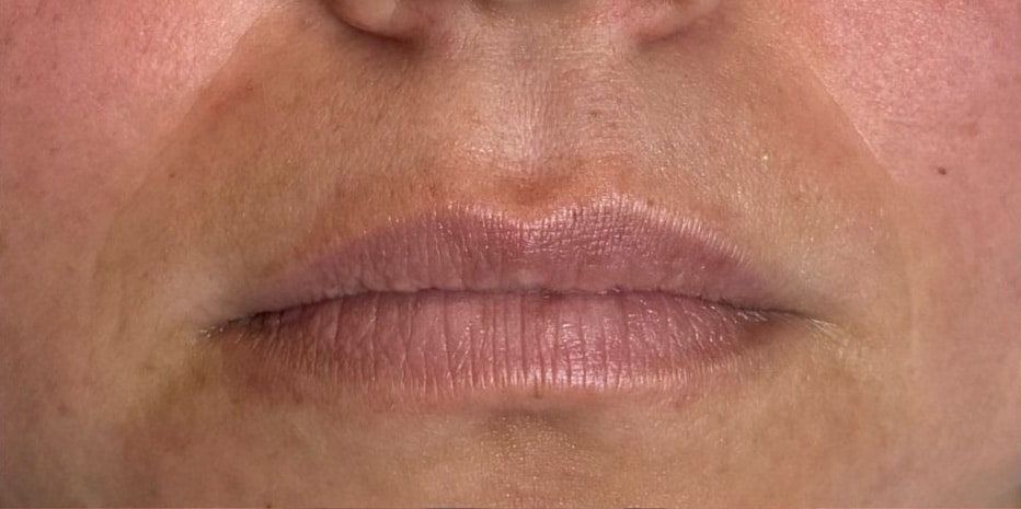 Before Image: Lip Filler - front